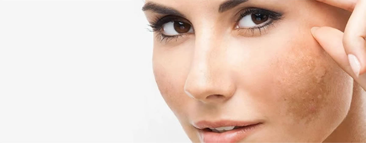 Spots on the skin: Why do dark spots appear on the skin and how to prevent them?