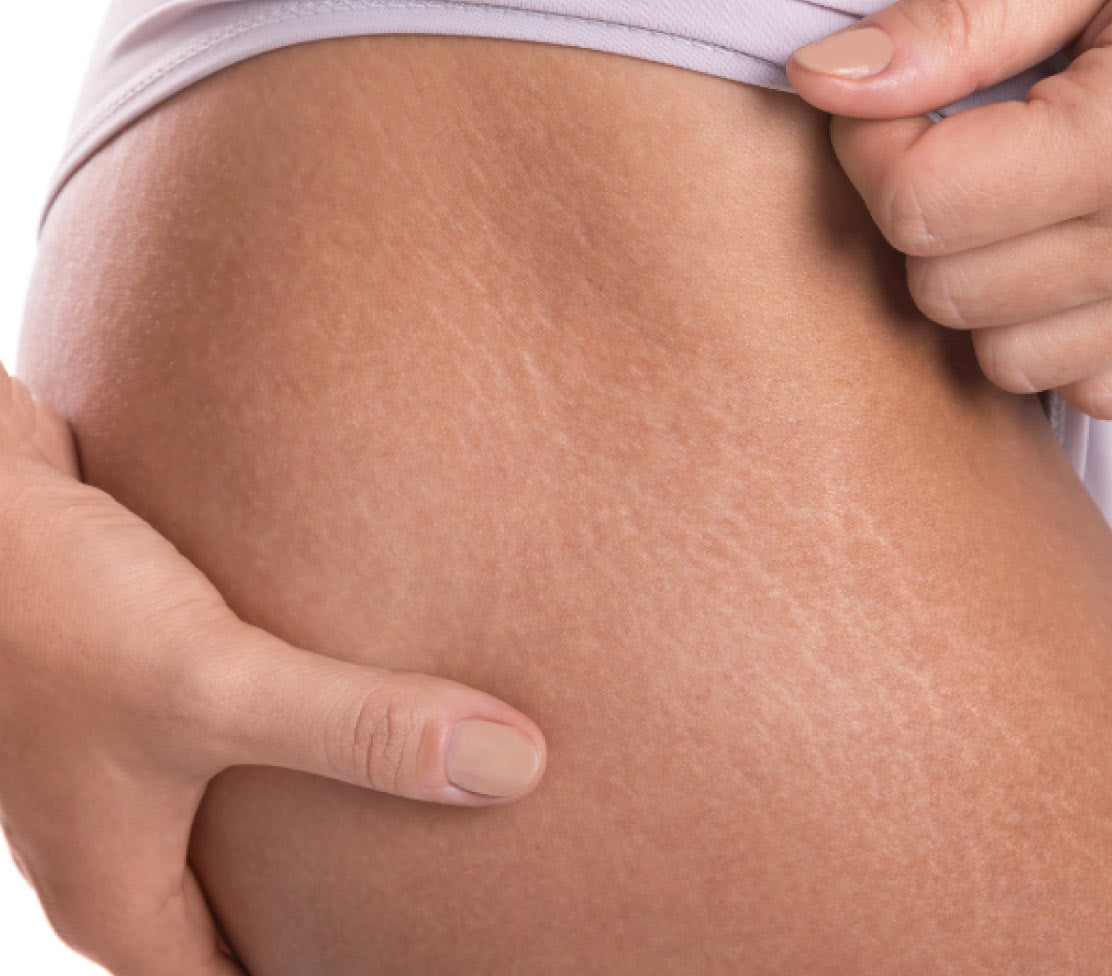 How to avoid stretch marks and reduce their appearance?