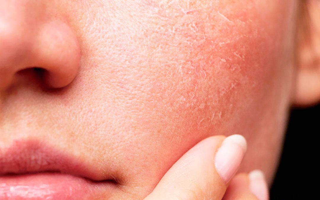 Why is your skin dry?  Main causes and solutions on how to keep it smooth