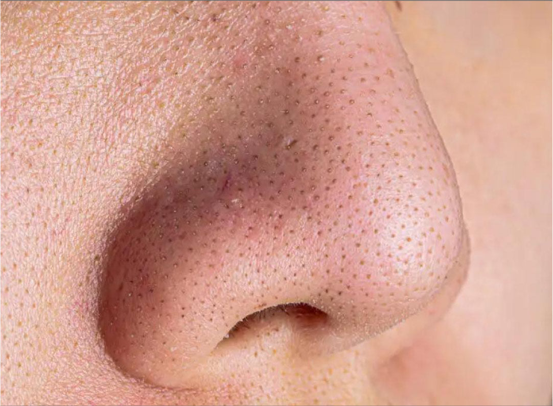 How to Remove Blackheads from Your Face? Follow These Tips