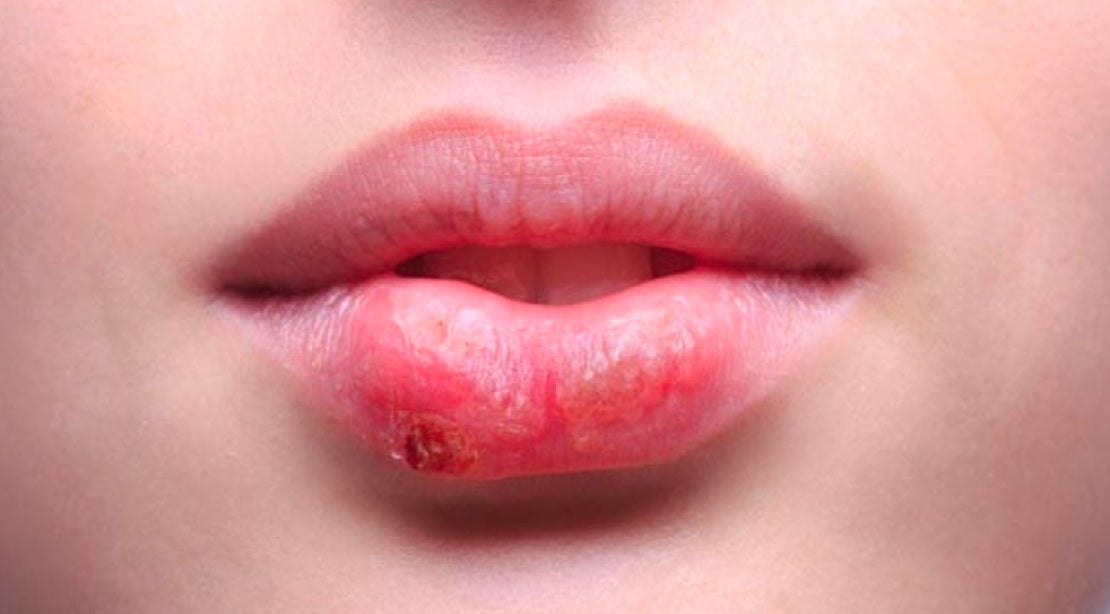 Cold sores: what are cold sores, symptoms, how to treat and prevent them