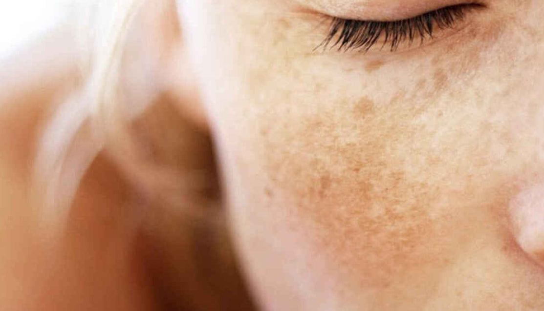 HOW TO COMBAT DARK SPOTS AFTER PREGNANCY?