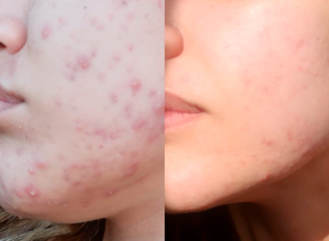 Saying Goodbye to Acne and Spots: Discover Healthy and Radiant Skin
