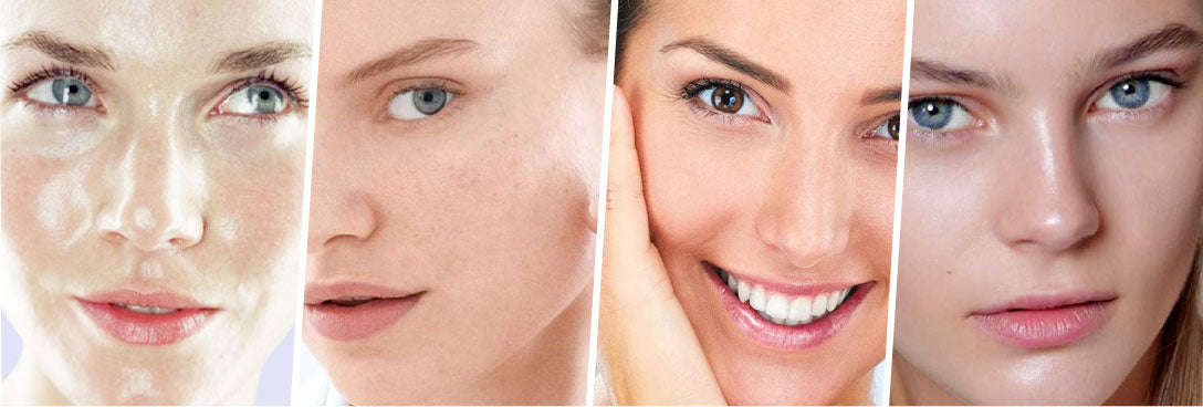 Skin Types