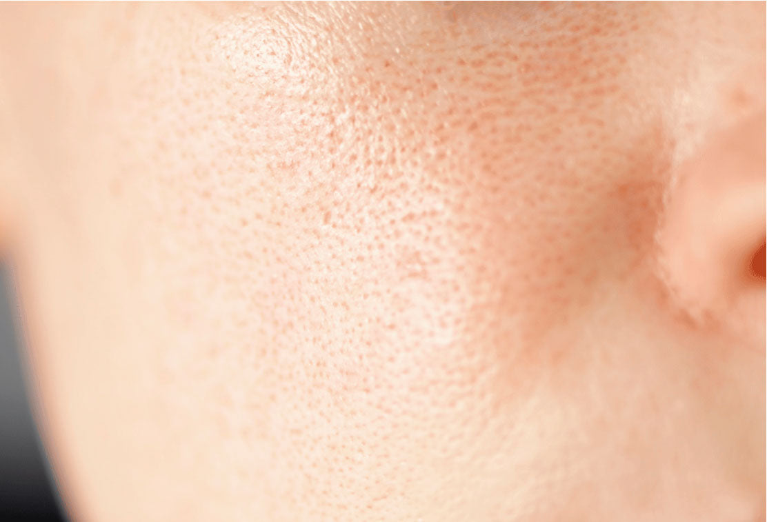 Open pores: causes and how to close them to improve your skin's appearance